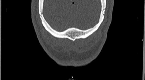 Central giant cell granuloma (Radiopaedia 83346-97761 Coronal bone window 55).jpg