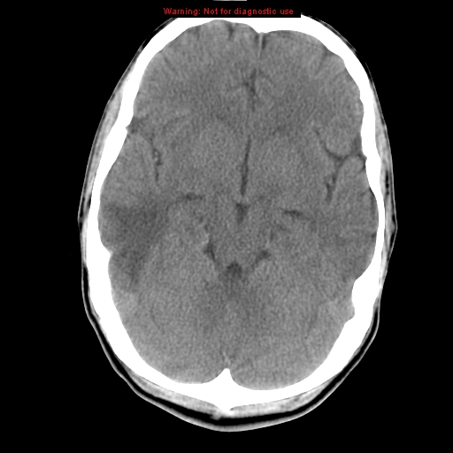 File:Central nervous system vasculitis (Radiopaedia 8410-9234 Axial non-contrast 10).jpg