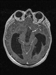 Central neurocytoma (Radiopaedia 56690-63469 Axial T1 C+ 65).jpg