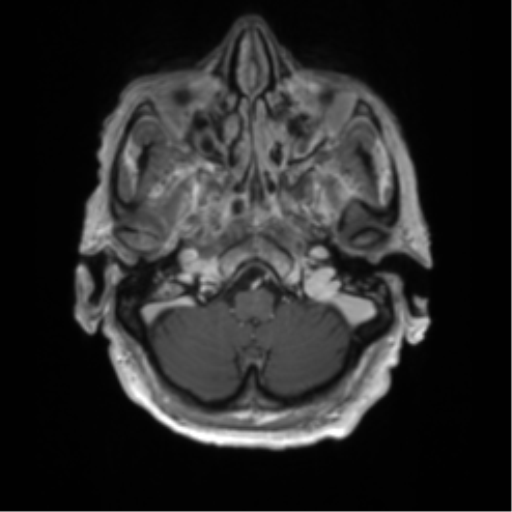 Central neurocytoma (Radiopaedia 65317-74345 Axial T1 C+ 2).png