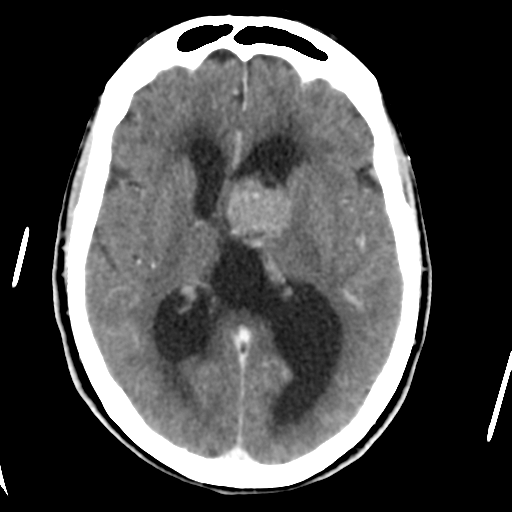Central neurocytoma (Radiopaedia 65317-74346 Axial C+ delayed 26).png