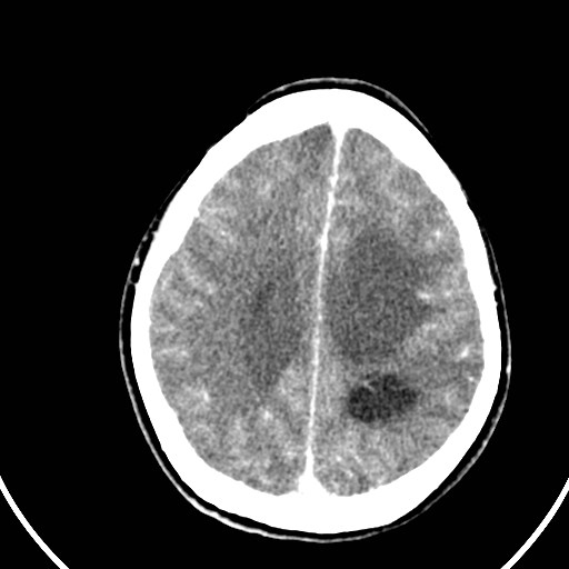 Central neurocytoma (Radiopaedia 84497-99871 B 36).jpg