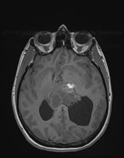 Central neurocytoma (Radiopaedia 84497-99872 Axial T1 104).jpg