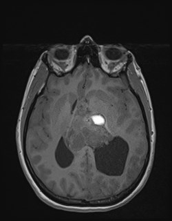 File:Central neurocytoma (Radiopaedia 84497-99872 Axial T1 106).jpg