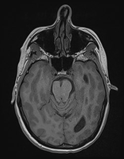 Central neurocytoma (Radiopaedia 84497-99872 Axial T1 72).jpg
