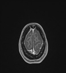Central neurocytoma (Radiopaedia 84497-99872 Axial T1 C+ 138).jpg