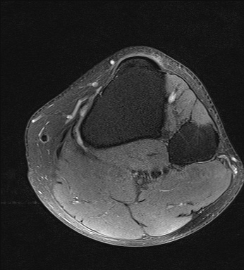 File:Central osteophyte (Radiopaedia 72592-83150 Axial PD fat sat 35).jpg