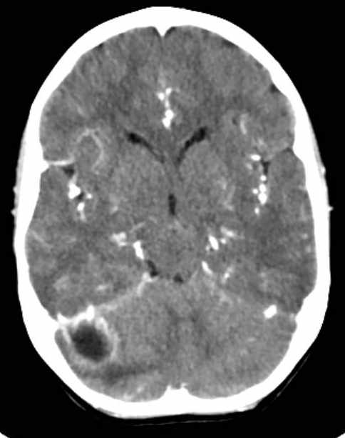 Cerebellar abscess (Radiopaedia 73727-84527 Axial C+ 33).jpg