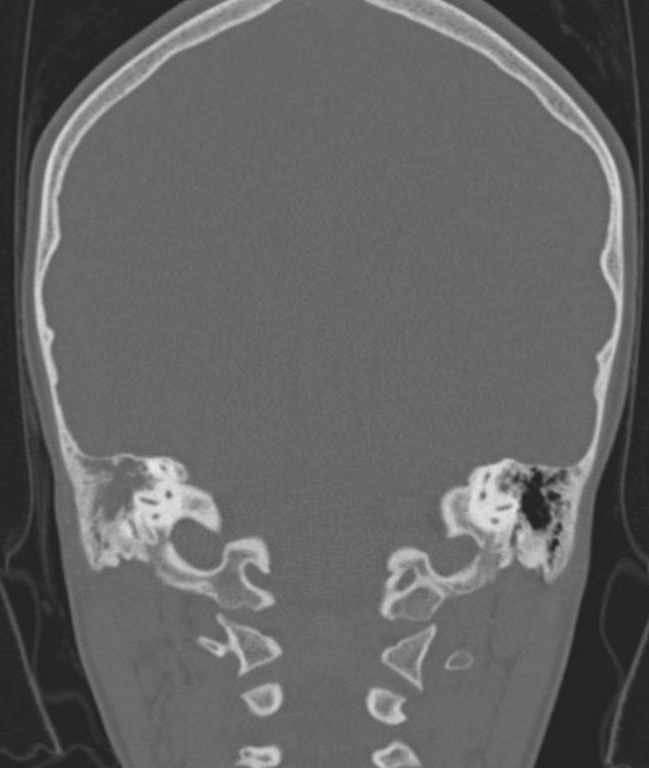 Cerebellar abscess (Radiopaedia 73727-84527 Coronal bone window 46).jpg