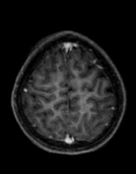 Cerebellar abscess (Radiopaedia 73727-84563 Axial T1 C+ fat sat 91).jpg