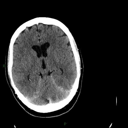 Cerebellar abscess (Radiopaedia 78135-90671 Axial C+ delayed 52).jpg