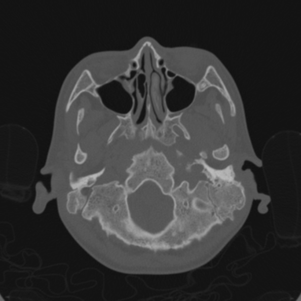 File:Cerebellar abscess secondary to mastoiditis (Radiopaedia 26284-26413 Axial bone window 26).jpg