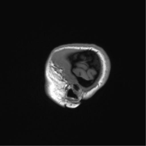 Cerebellar agenesis with hypoplastic pons (pontocerebellar hypoplasia) (Radiopaedia 57224-64138 Sagittal T1 12).png