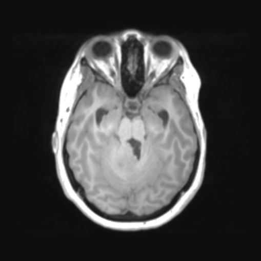 File:Cerebellar ependymoma complicated by post-operative subdural hematoma (Radiopaedia 83322-97736 Axial T1 16).png