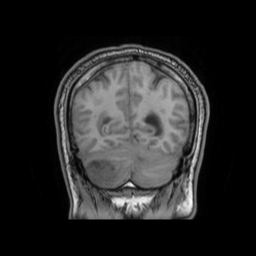 File:Cerebellar hemangioblastoma (Radiopaedia 88055-104622 Coronal T1 29).jpg
