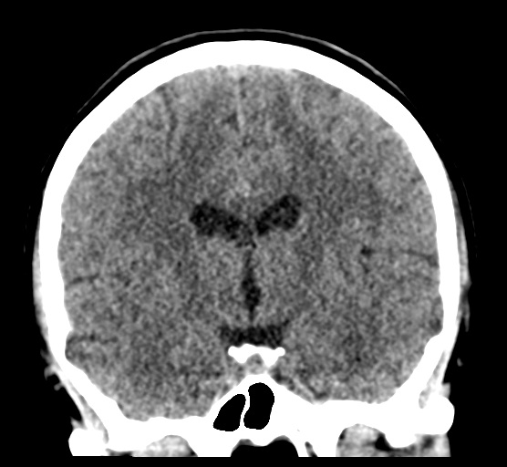 File:Cerebellar metastases - colorectal adenocarcinoma (Radiopaedia 40947-43652 Coronal non-contrast 49).png
