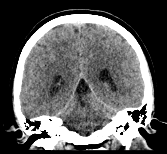 Cerebellar metastases - colorectal adenocarcinoma (Radiopaedia 40947-43652 Coronal non-contrast 62).png