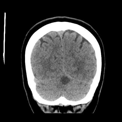 Cerebellar metastasis (cystic appearance) (Radiopaedia 41395-44258 Coronal non-contrast 50).png