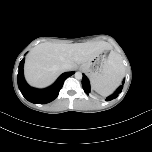 Cerebellar metastasis - adenocarcinoma lung (Radiopaedia 63184-71717 Axial C+ delayed 62).png