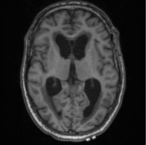 Cerebellar metastasis from lung adenocarcinoma (Radiopaedia 86690-102829 Axial T1 43).png