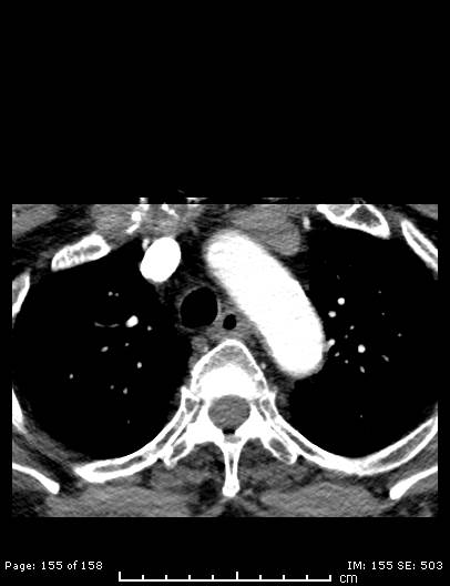 Cerebellar strokes due to intracranial giant cell arteritis (Radiopaedia 68799-78510 CT angiogram 155).jpg