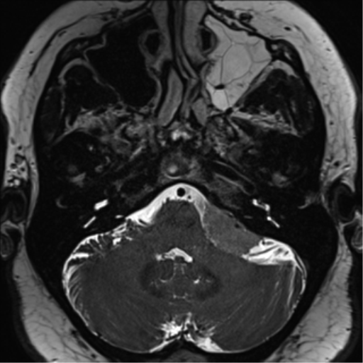 Cerebellopontine angle meningioma (Radiopaedia 48434-53348 Axial T2 Space 46).png