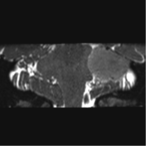 Cerebellopontine angle meningioma (Radiopaedia 48434-53348 Coronal T2 36).png