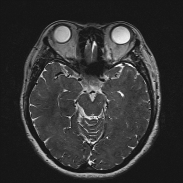 Cerebellopontine angle meningioma (Radiopaedia 53561-59591 Axial 3D volume T2 97).jpg