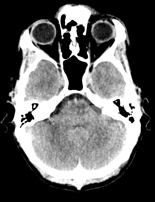Cerebral abscess (Radiopaedia 60342-68008 Axial non-contrast 14).png