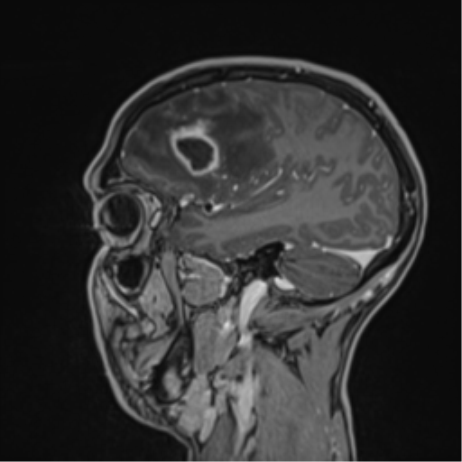 Cerebral abscess (Radiopaedia 60342-68009 J 42).png