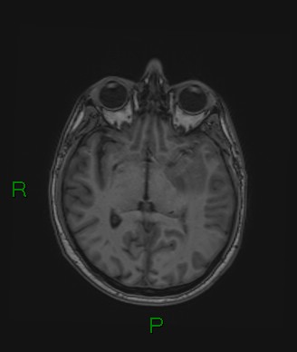 Cerebral abscess and subdural empyema (Radiopaedia 84436-99779 Axial T1 47).jpg