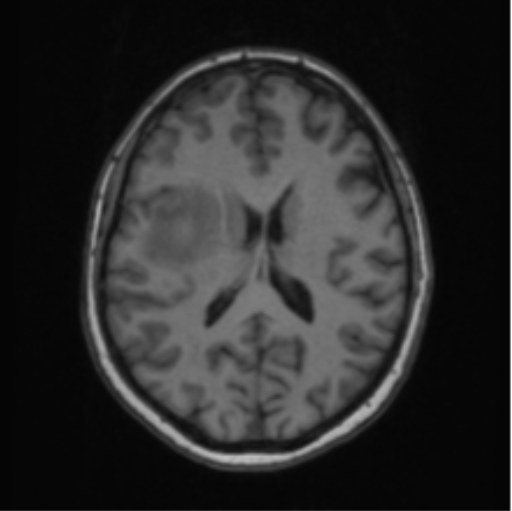 Cerebral abscess from pulmonary arteriovenous malformation (Radiopaedia 86275-102291 Axial T1 45).png