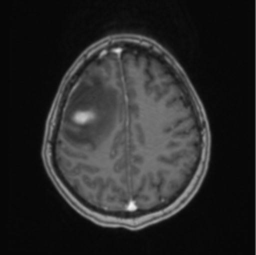 Cerebral abscess from pulmonary arteriovenous malformation (Radiopaedia 86275-102291 Axial T1 C+ 55).png