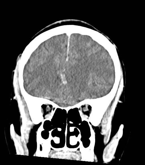 Cerebral abscesses (Radiopaedia 70458-80568 Coronal Contrast 21).jpg
