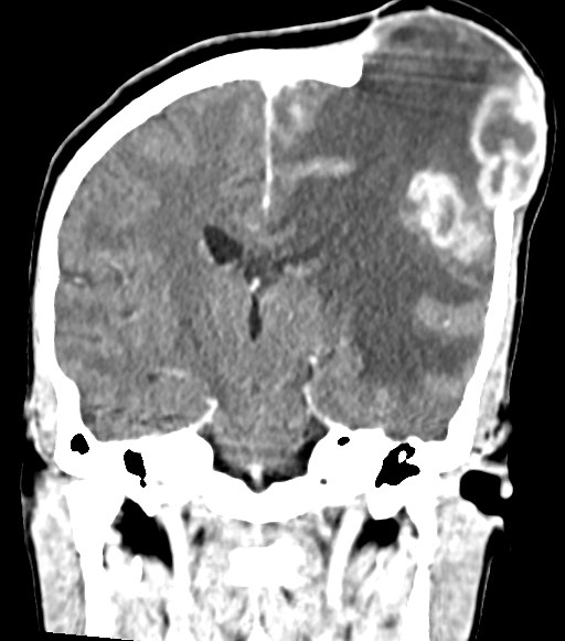 Cerebral abscesses (Radiopaedia 70458-80568 Coronal Contrast 37).jpg