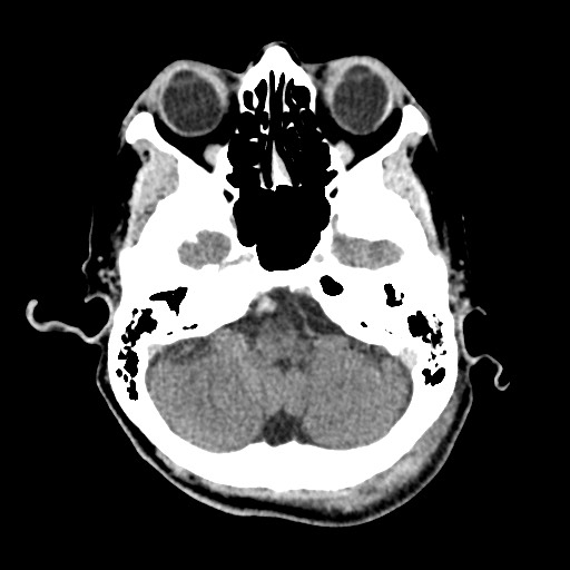File:Cerebral amyloid angiopathy-related inflammation (Radiopaedia 74836-85848 Axial non-contrast 15).jpg