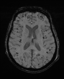 File:Cerebral amyloid angiopathy-related inflammation (Radiopaedia 74836-85849 Axial SWI 42).jpg
