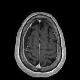 File:Cerebral amyloid angiopathy (Radiopaedia 29129-29518 Axial T1 C+ 125).jpg