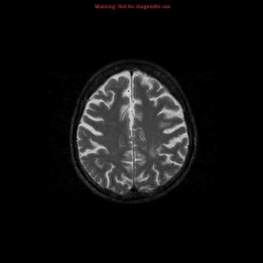 File:Cerebral and orbital tuberculomas (Radiopaedia 13308-13311 Axial T2 16).jpg