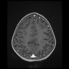 Cerebral and spinal tuberculosis (Radiopaedia 90489-107837 Axial T1 C+ 150).jpg