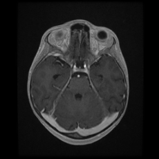Cerebral and spinal tuberculosis (Radiopaedia 90489-107837 Axial T1 C+ 75).jpg