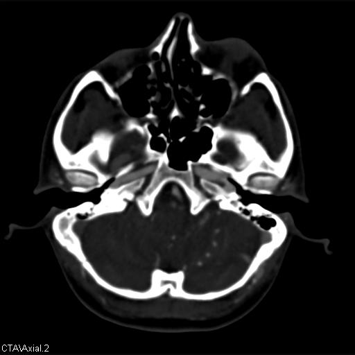 Cerebral arteriovenous malformation (Radiopaedia 28518-28759 B 2).jpg