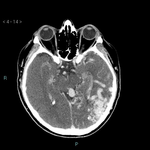 File:Cerebral arteriovenous malformation (Radiopaedia 40528-43125 Axial C+ delayed 14).jpg