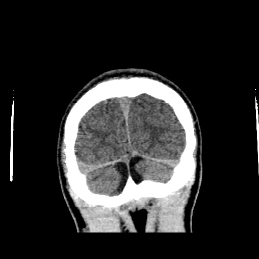 Cerebral arteriovenous malformation (Radiopaedia 61964-70028 Coronal non-contrast 55).jpg