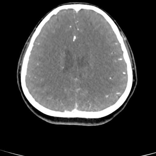Cerebral arteriovenous malformation (Radiopaedia 73830-84645 B 36).jpg