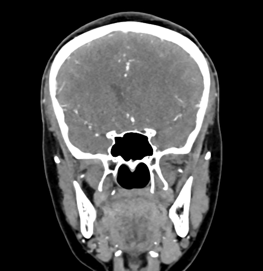 Cerebral arteriovenous malformation (Radiopaedia 73830-84645 C 37).jpg
