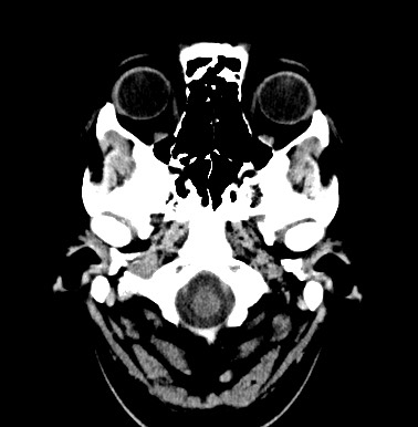 File:Cerebral arteriovenous malformation (Radiopaedia 74411-85744 Axial non-contrast 1).jpg