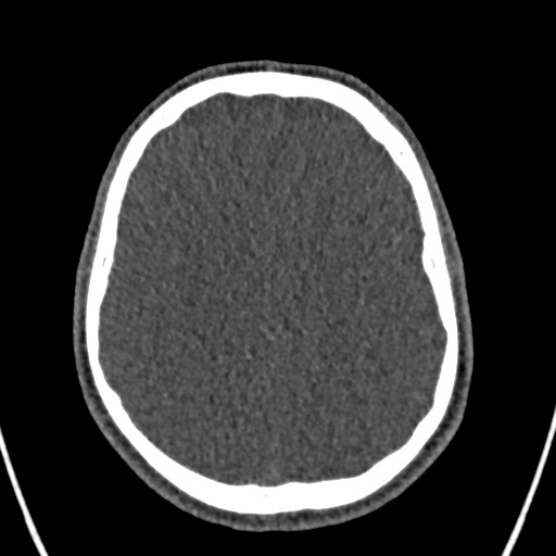 Cerebral arteriovenous malformation (Radiopaedia 78188-90746 Axial non-contrast 125).jpg