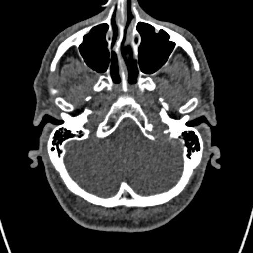 Cerebral arteriovenous malformation (Radiopaedia 78188-90746 Axial non-contrast 29).jpg