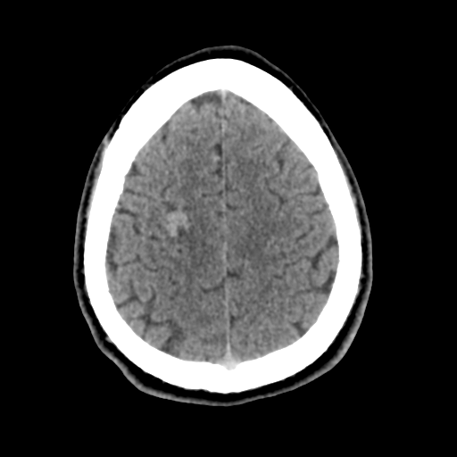 Cerebral arteriovenous malformation (Spetzler-Martin grade 2) (Radiopaedia 41262-44076 Axial non-contrast 44).png
